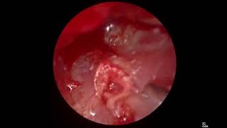 Endoscopic quotClip myringoplastyquot [upl. by Charo183]