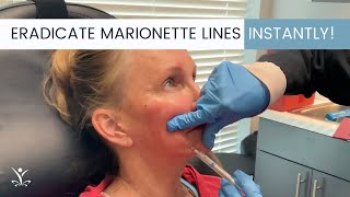 Get Instant Results with Filler for Marionette Lines [upl. by Jona]