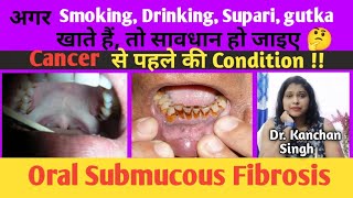 Osmf treatment in hindi Oral submucous fibrosis cause and treatment Dr Kanchan Singh [upl. by Calista]