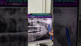 braces orthodontist orthodontictreatment tmj [upl. by Sualk]