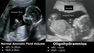 Obstetric Ultrasound Normal Vs Abnormal Images  Fetal Placenta Umbilical Cord Pathologies USG [upl. by Silrac484]