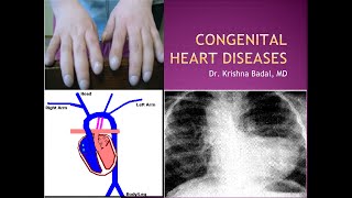 Congenital heart diseases [upl. by Idnew]