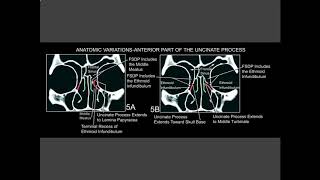 Uncinate process [upl. by Guyon214]