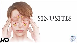 Sinusitis Everything You Need To Know [upl. by Colby267]