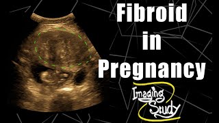 Pregnancy with Uterine Fibroid  Ultrasound  Case 76 [upl. by Bernstein]