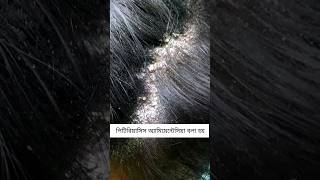 Pityriasis amiantacea 🔥 skincare haircare dandruff psoriasis [upl. by Kenti906]