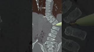 Scoliosis with Hemi vertebra  Treatment options  when surgery should be done spine pune doctor [upl. by Lynsey]