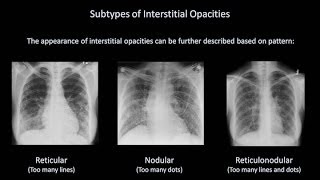 How to Interpret a Chest XRay Lesson 7  Diffuse Lung Processes [upl. by Adnavoj]