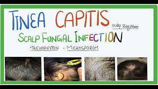 Tinea Capitis fungal infection of scalp causes transmission clinical features and Treatment [upl. by Adnawal177]