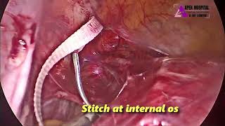 Laparoscopic Abdominal Cerclage by Dr R K Mehta  Apex Hospital Sirsa [upl. by Oilalue351]