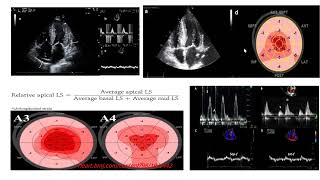 Cardiac amyloidosis  Multimodality assessment [upl. by La Verne135]