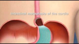 Barretts Esophagus Intestinal Metaplasia of the CardiaMayo Clinic [upl. by Aisile]