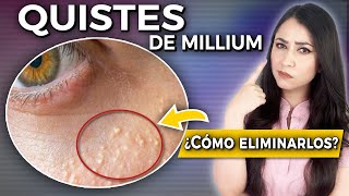 QUISTES DE MILLIUM l ¿Qué son y CÓMO ELIMINARLOS👩🏻‍⚕️ drapauzuniga [upl. by Maiah]