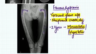 cystic lesions of bone basics [upl. by Halyak28]