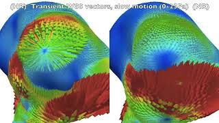 Wall shear stress instabilities in a cerebral aneurysm [upl. by Dnilazor414]