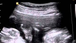 Clinodactyly diagnosed by ultrasound in Down Syndrome [upl. by Ycnahc]