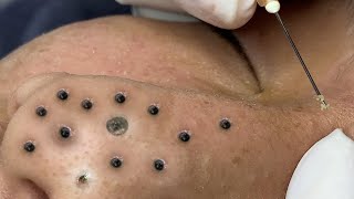 Big Cystic Acne Blackheads Extraction Blackheads amp Milia Whiteheads Removal Pimple Popping  3717 [upl. by Darda305]