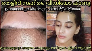 OMG 😱😱how to remove pimples and marksget glowing skinremove black Heads White headsclinmiskin gel [upl. by Mikes]