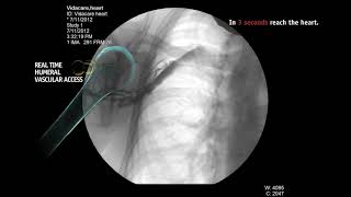 Intraosseous Infusion From Right Humeral Head [upl. by Nieberg]