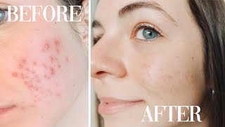 How I Cleared Up My Acne Tretinoin Doxycycline  Accutane  Big Sister Talks [upl. by Nnylear]