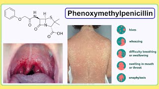 phenoxymethylpenicillin [upl. by Tripp7]