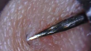 Ingrown hair popped removed with tweezers [upl. by Hartzke966]