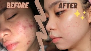 The best ANTI ACNE CREAM ✨  my holy grail  TRETINOIN [upl. by Nasya]