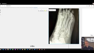 My experience with fifth metatarsal fracture  recovery timeline UK NHS what you should expect [upl. by Kallick]