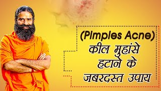 कील – मुहांसे PimplesAcne हटाने के जबरदस्त उपाय  Swami Ramdev [upl. by Turpin]