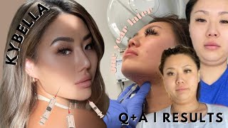 KYBELLA QA  1 year later recap  WELCOME BACK to my new beauty blog kybella kybellaresults [upl. by Andres]