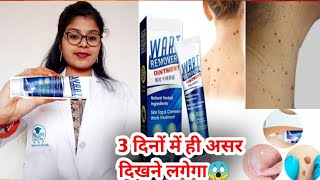 Wart Remover Ointment honest review 2023Wart Remover Ointment benefit usesampsideeffects review hindi [upl. by Danielle]