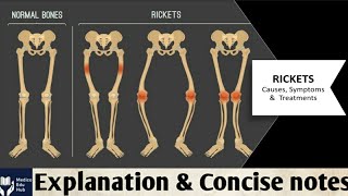 RicketsCauses amp Symptoms in hindi Pathology for medical students [upl. by Aiza526]