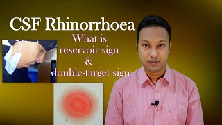 CSF Rhinorrhoea or Cerebrospinal Fluid Leak through Nose Signs Symptoms Diagnosis amp Treatment [upl. by Va]