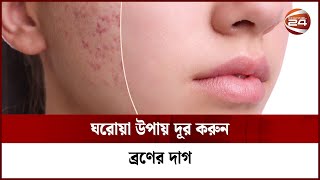 যেভাবে দূর করবেন ব্রণের দাগ  Channel 24 [upl. by Juliane645]