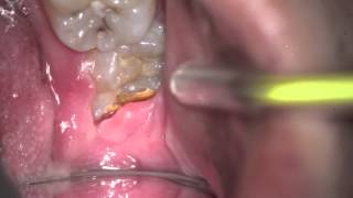 Wisdom Teeth need extraction for various reasons [upl. by Adair]