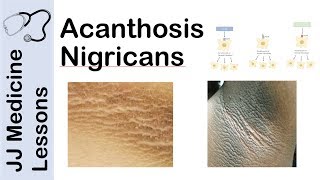 Acanthosis Nigricans  Risks Pathogenesis and Treatments [upl. by Anner]