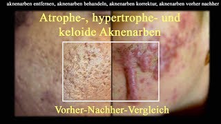 Atrophe hypertrophe und keloide Aknenarben VorherNachherVergleich [upl. by Jane]