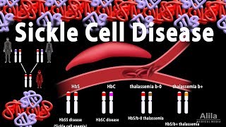 Sickle Cell Disease Animation [upl. by Christyna41]