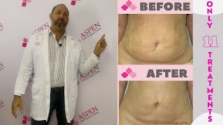 Liposuction Fibrosis Treatment Soften and Smooth Lumps and Bumps [upl. by Homans]