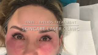 TIXEL EYELIDS TREATMENT  SKINCARE LASER CLINIC POINTCOOK MELBOURNE [upl. by Galatea]