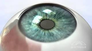 Pterygium Animation [upl. by Kazimir]