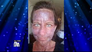 Neurofibromatosis  Incredible Before amp After Transformation [upl. by Lawrenson686]