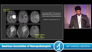 What Every Neuropathologist Needs to Know Adult Diffuse Glioma The Neuroradiologist Perspective [upl. by Maddis]