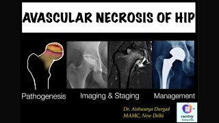 AVASCULAR NECROSIS OF HIPClinicoradiological discussionDetailed review of Imaging amp Staging of AVN [upl. by Brittney]