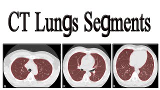 CT lungs segments [upl. by Karlan]