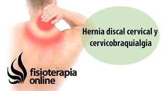 Hernia discal cervical y cérvicobraquialgia [upl. by Dodi]