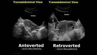 Uterine Positions In Ultrasound  AntevertedRetroverted  AnteflexedRetroflexed Uterus [upl. by Tudor]