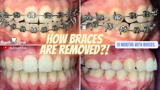 How Braces Are Removed  Open Bite Fixed 18 months Tooth Time Family Dentistry New Braunfels Texas [upl. by Royden515]