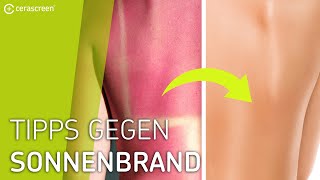 So musst du Sonnenbrand behandeln  Tipps gegen Sonnenbrand [upl. by Yelyab]