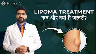 Doctor Explains Lipoma  When To Treat Lipoma  Best Treatment for Lipoma  Lipoma Removal in Delhi [upl. by Kemp]